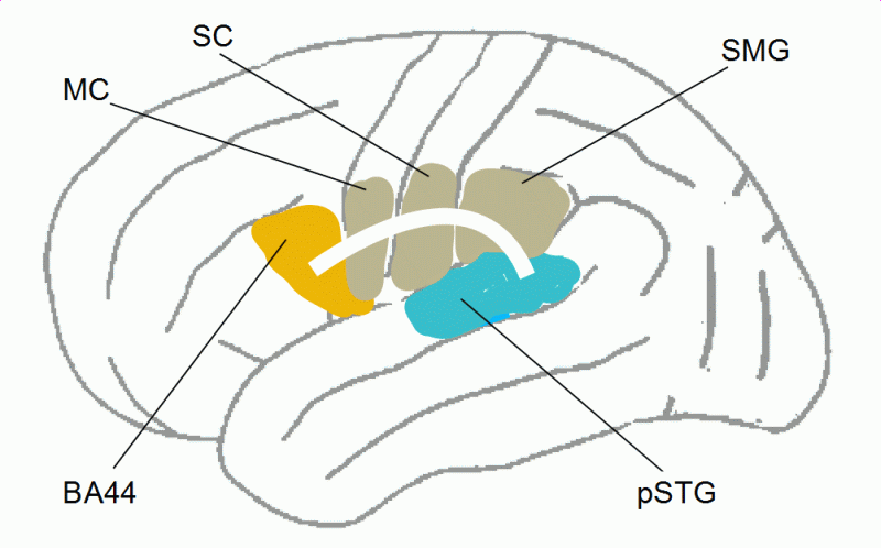 Theory of stuttering: white matter tracts, left SLF or arcuate fasciculus